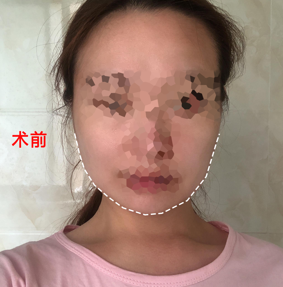 听人家说,男要俏,一身皂;女要俏 成都华西口腔医院罗恩、李继华磨骨谁做的好?【案例图】