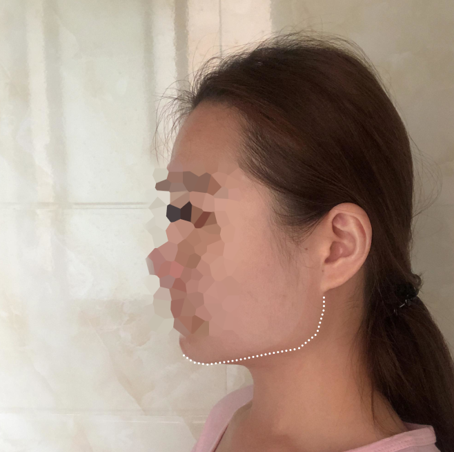 听人家说,男要俏,一身皂;女要俏 成都华西口腔医院罗恩、李继华磨骨谁做的好?【案例图】