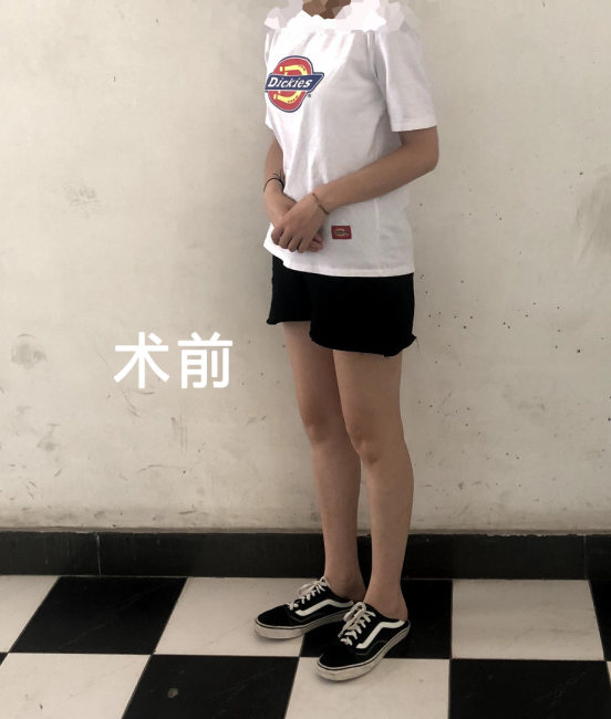 现在已经恢复了2个月了，这段时间里腿型是越来越好看了 济南艺星整形吸脂案例图投稿