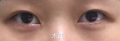 广州暨南大学附属第(一)医院(广州华侨)卢金强微创三点+开眼角