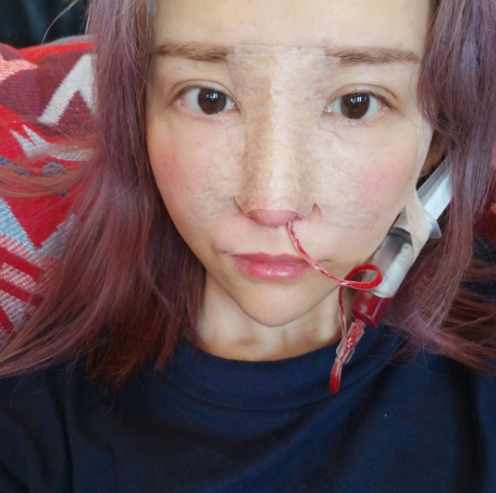 武汉隆鼻手术干货分享 在经历了各种犹豫纠结后我终于做了鼻部手术。做完当场就后悔了，咋没早点做呢?