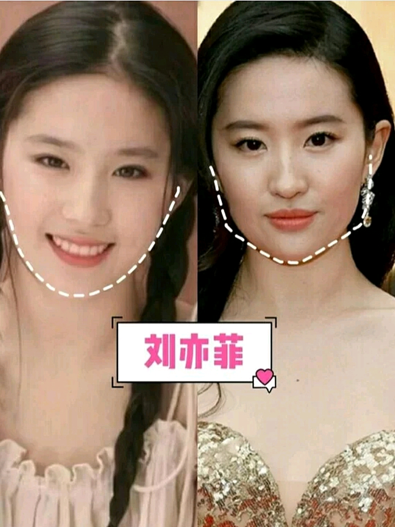 发腮”的杀伤力到底有多狠?下颌明X变得方钝,脸比以前大不止一倍!
