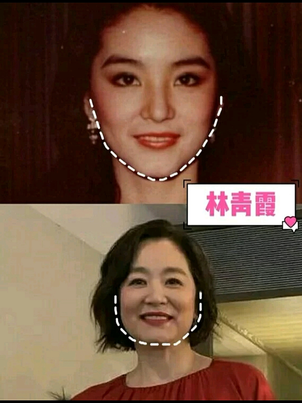 发腮”的杀伤力到底有多狠?下颌明X变得方钝,脸比以前大不止一倍!