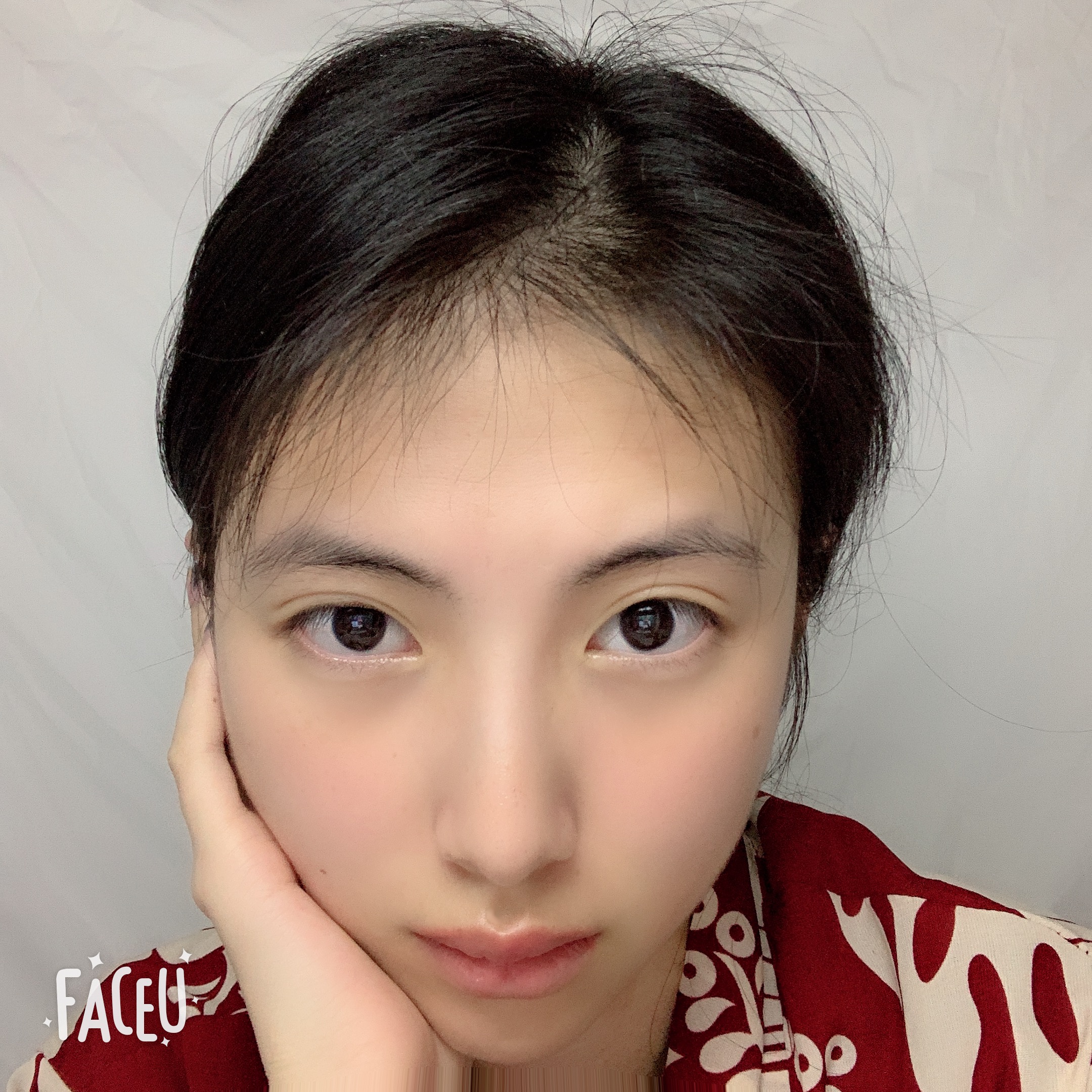 做完下颌角削骨一个半月了，嘴巴能张得大一些了，差不多两指吧。也能嚼一些东西了，脸上紧绷的感觉要好很多