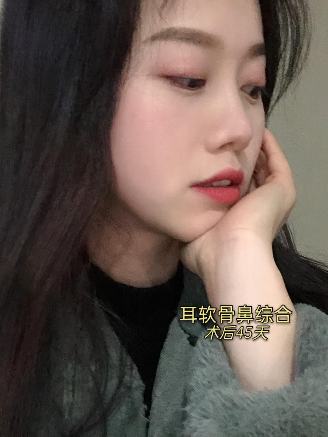 自从做了隆鼻,我就一直没怎么吃辣,尤其刚开始,真的一丁点辣的也不敢碰
