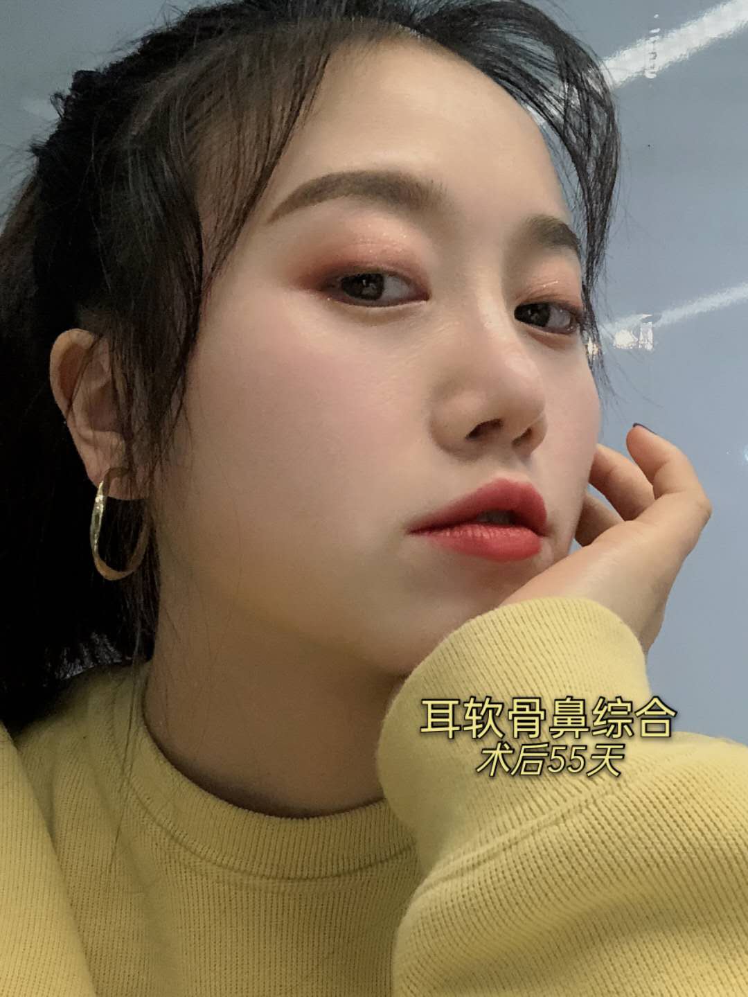 自从做了隆鼻,我就一直没怎么吃辣,尤其刚开始,真的一丁点辣的也不敢碰