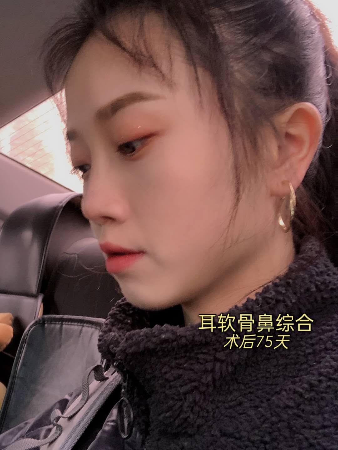 自从做了隆鼻,我就一直没怎么吃辣,尤其刚开始,真的一丁点辣的也不敢碰