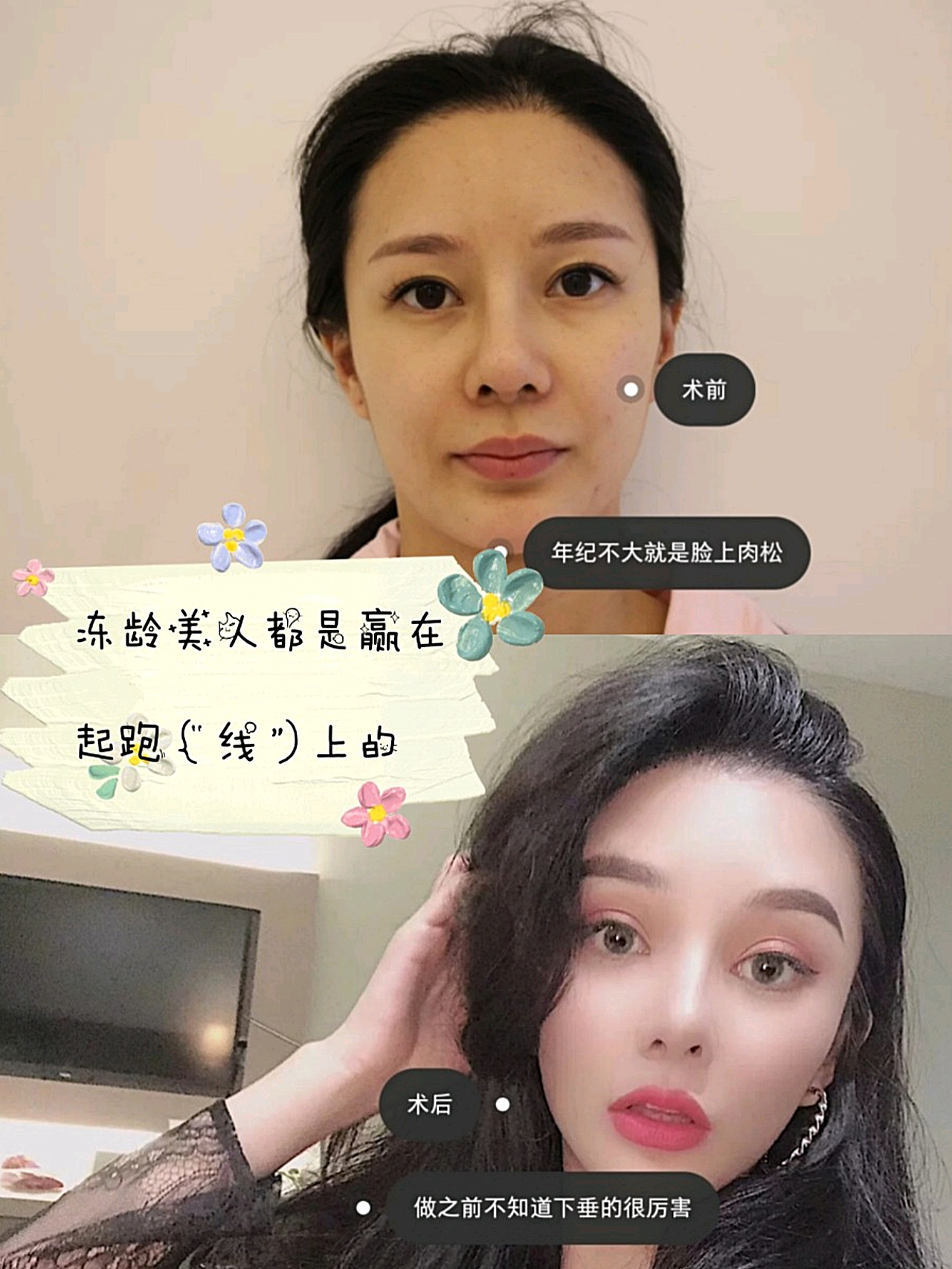 温州全脸埋线提升一个月,大家觉得*果好吗???一个月的时候,*果真的很*