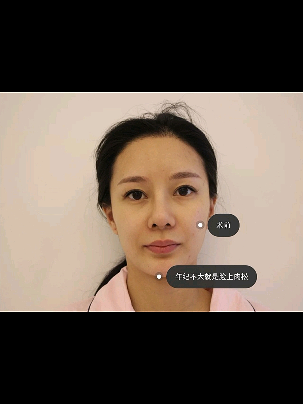 温州全脸埋线提升一个月,大家觉得*果好吗???一个月的时候,*果真的很*