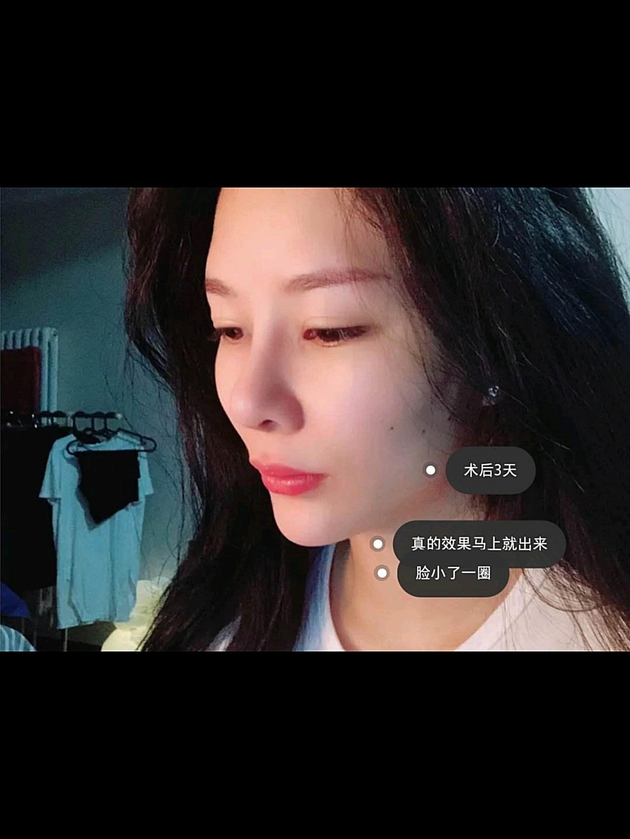 温州全脸埋线提升一个月,大家觉得*果好吗???一个月的时候,*果真的很*