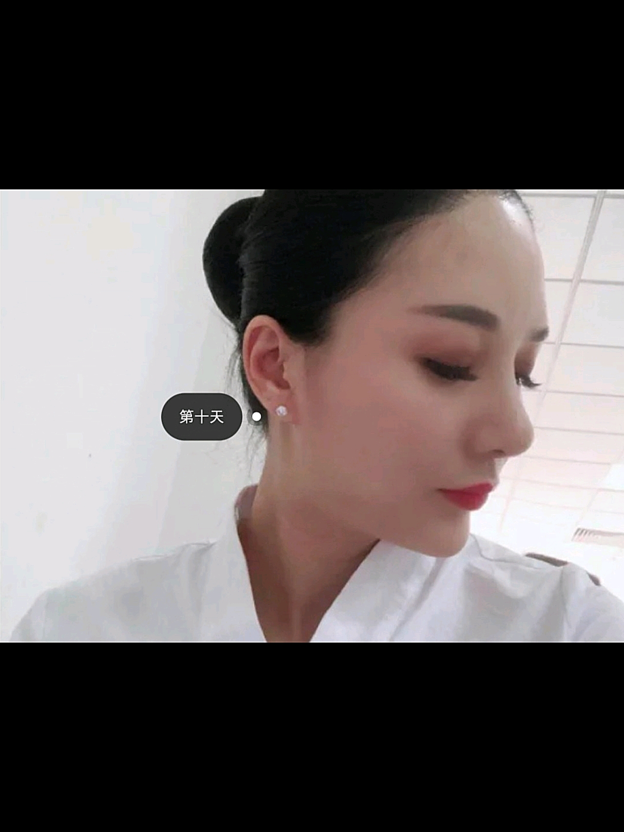 温州全脸埋线提升一个月,大家觉得*果好吗???一个月的时候,*果真的很*