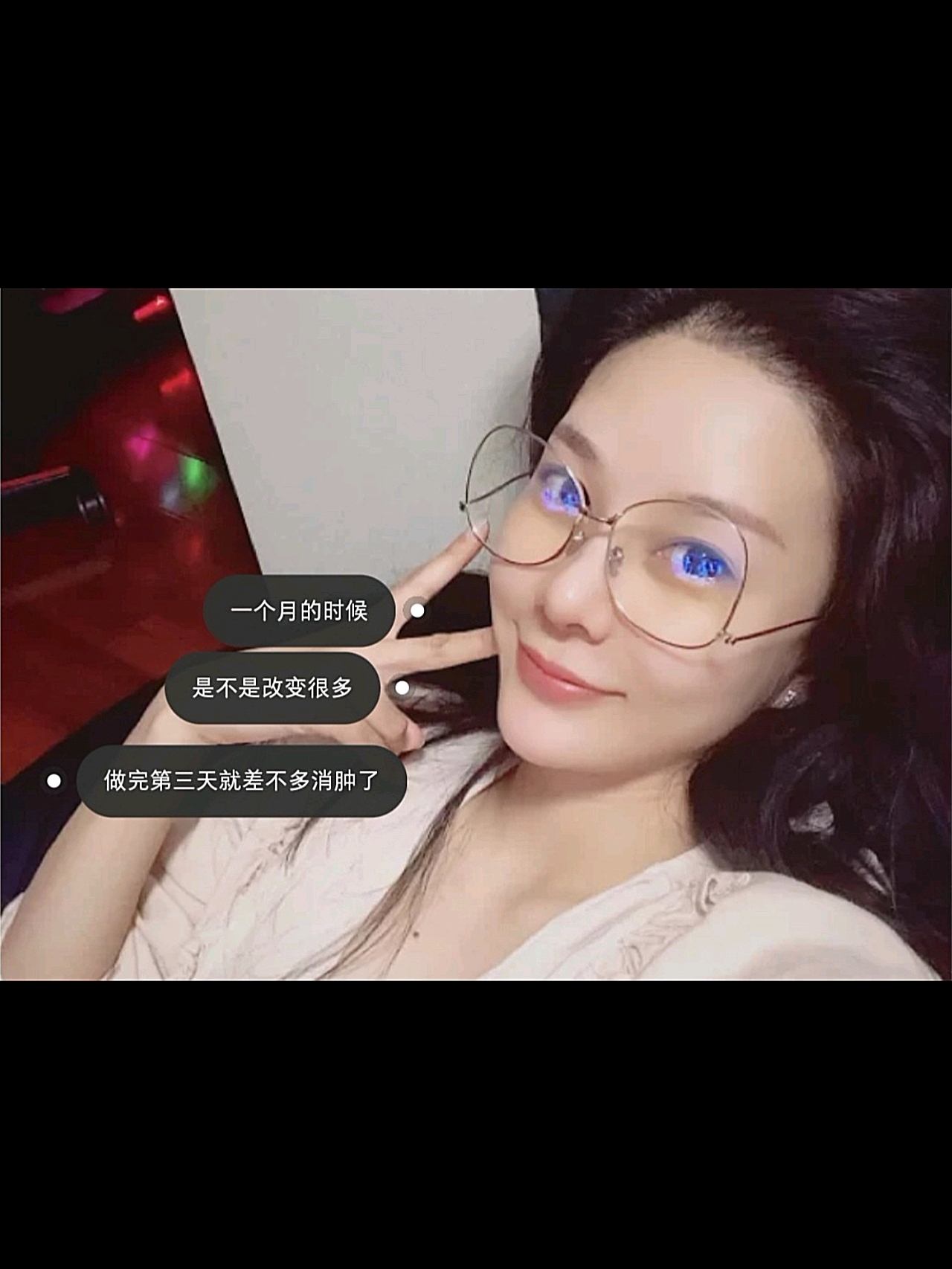 温州全脸埋线提升一个月,大家觉得*果好吗???一个月的时候,*果真的很*