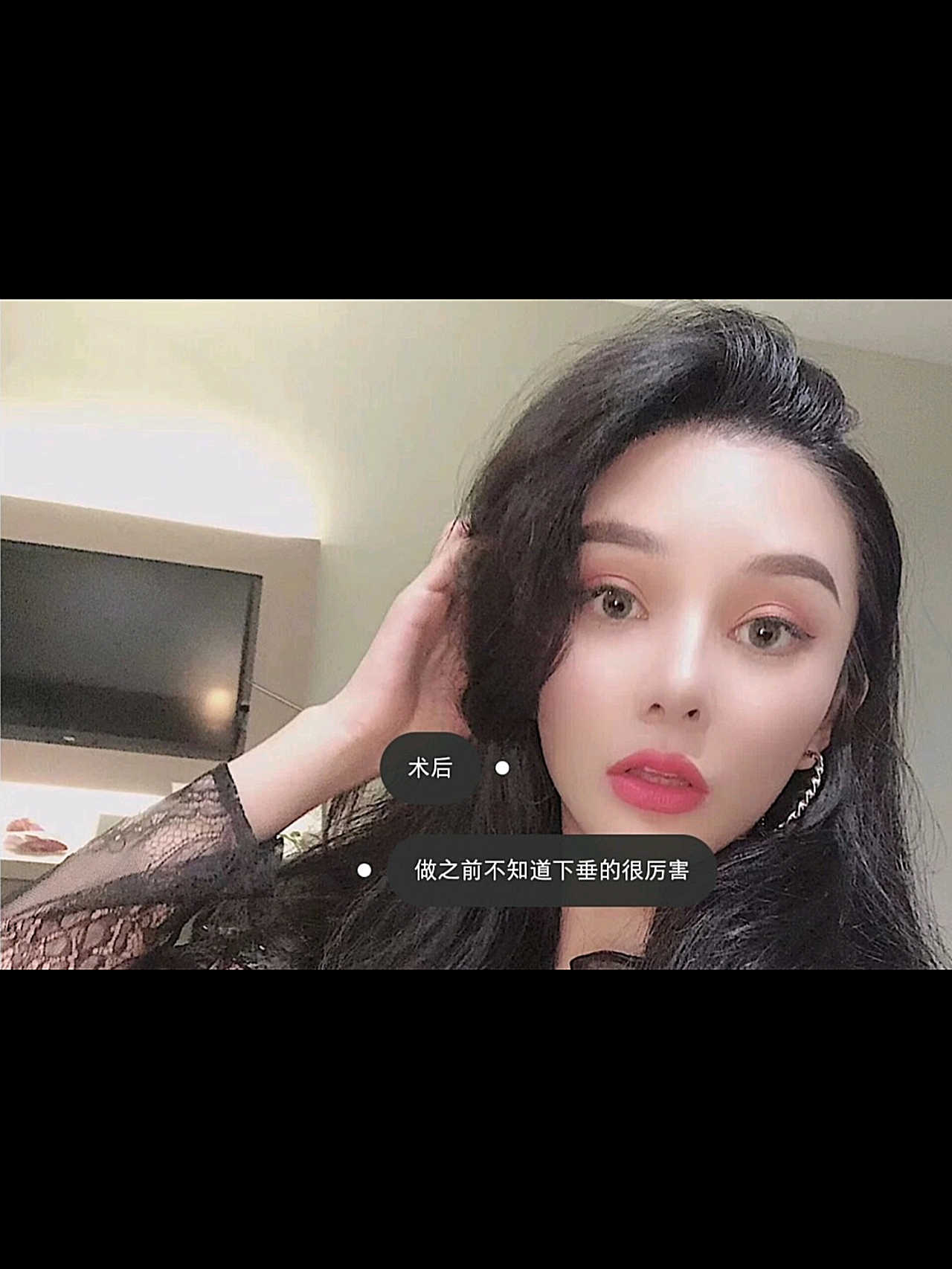 温州全脸埋线提升一个月,大家觉得*果好吗???一个月的时候,*果真的很*