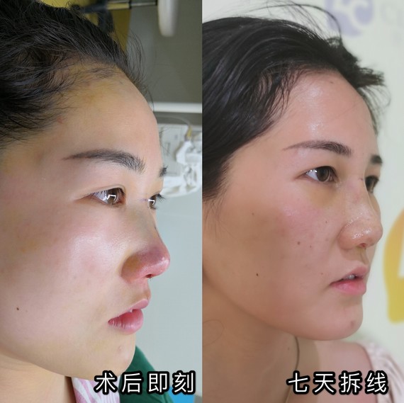 【案例分享】告别土气秒变异域风女神 拉低颜值的“丑鼻子”,肉鼻头就是其中之一。它有三大特征,看看你有吗?