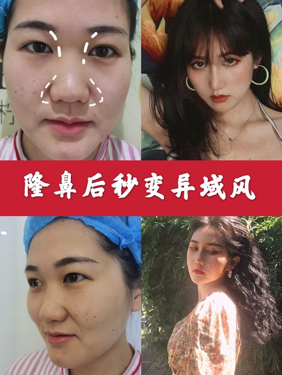 【案例分享】告别土气秒变异域风女神 拉低颜值的“丑鼻子”,肉鼻头就是其中之一。它有三大特征,看看你有吗?
