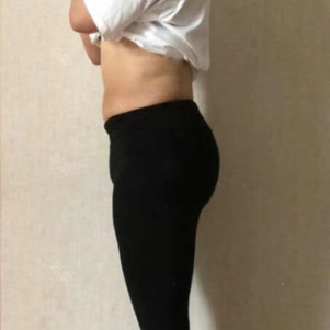 吸脂手术无门槛?NO 抽脂适合和不适合人群是哪些?杭州华山连天美吸脂案例图