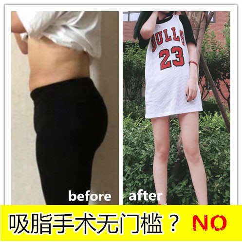 吸脂手术无门槛？NO 抽脂适合和不适合人群是哪些？杭州华山连天美吸脂案例图