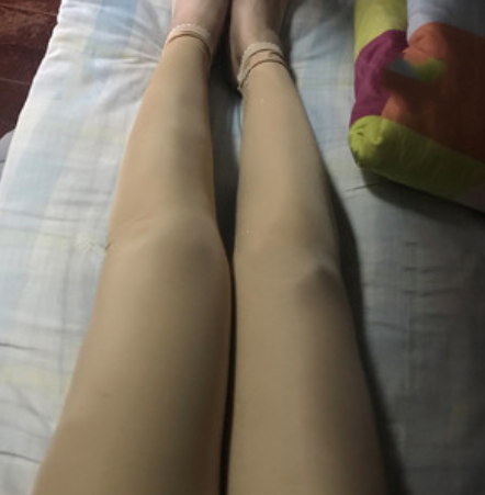 吸脂手术无门槛?NO 抽脂适合和不适合人群是哪些?杭州华山连天美吸脂案例图