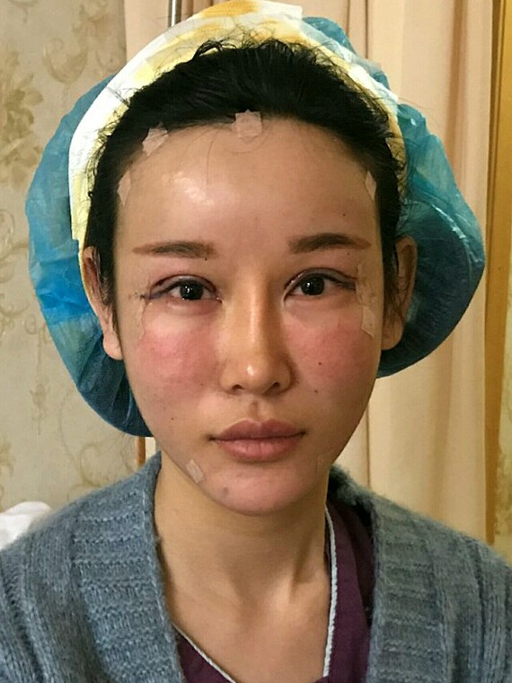 只要额头变得扁平,侧颜看起来 不言而喻 北京东方和谐自体脂肪填充多少钱?冯斌怎么样?【点击咨询】