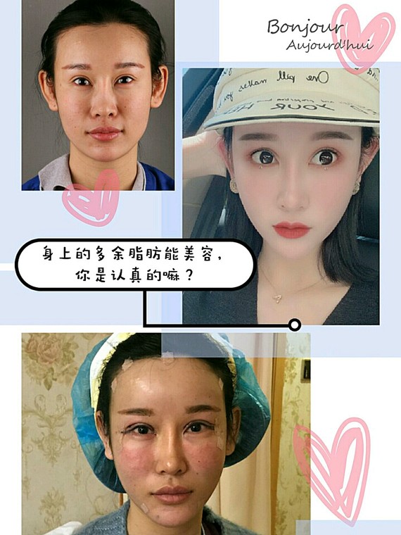 只要额头变得扁平,侧颜看起来 不言而喻 北京东方和谐自体脂肪填充多少钱?冯斌怎么样?【点击咨询】