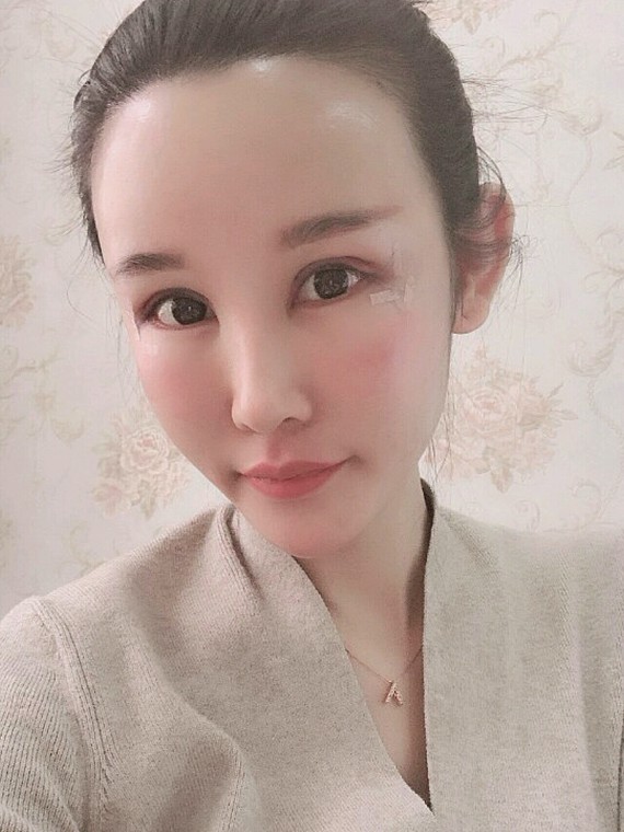 只要额头变得扁平,侧颜看起来 不言而喻 北京东方和谐自体脂肪填充多少钱?冯斌怎么样?【点击咨询】