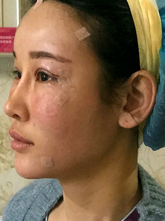 只要额头变得扁平,侧颜看起来 不言而喻 北京东方和谐自体脂肪填充多少钱?冯斌怎么样?【点击咨询】