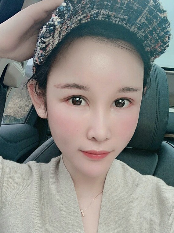 只要额头变得扁平,侧颜看起来 不言而喻 北京东方和谐自体脂肪填充多少钱?冯斌怎么样?【点击咨询】