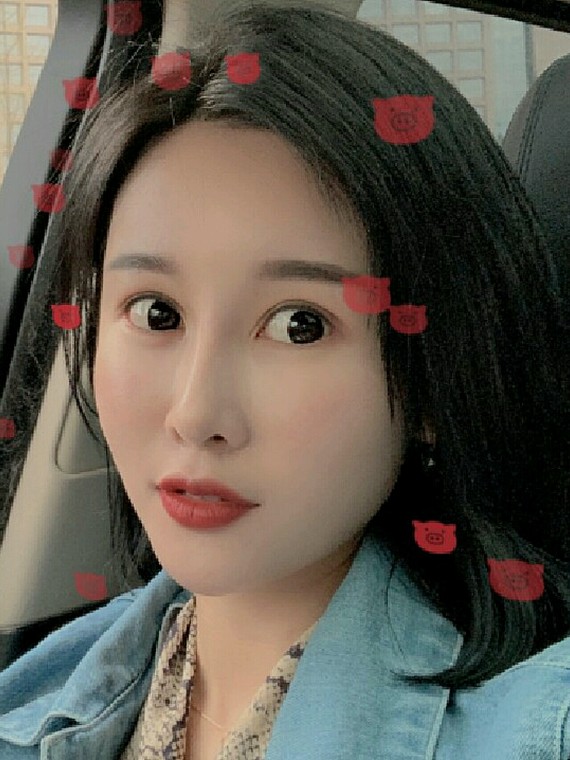 只要额头变得扁平,侧颜看起来 不言而喻 北京东方和谐自体脂肪填充多少钱?冯斌怎么样?【点击咨询】