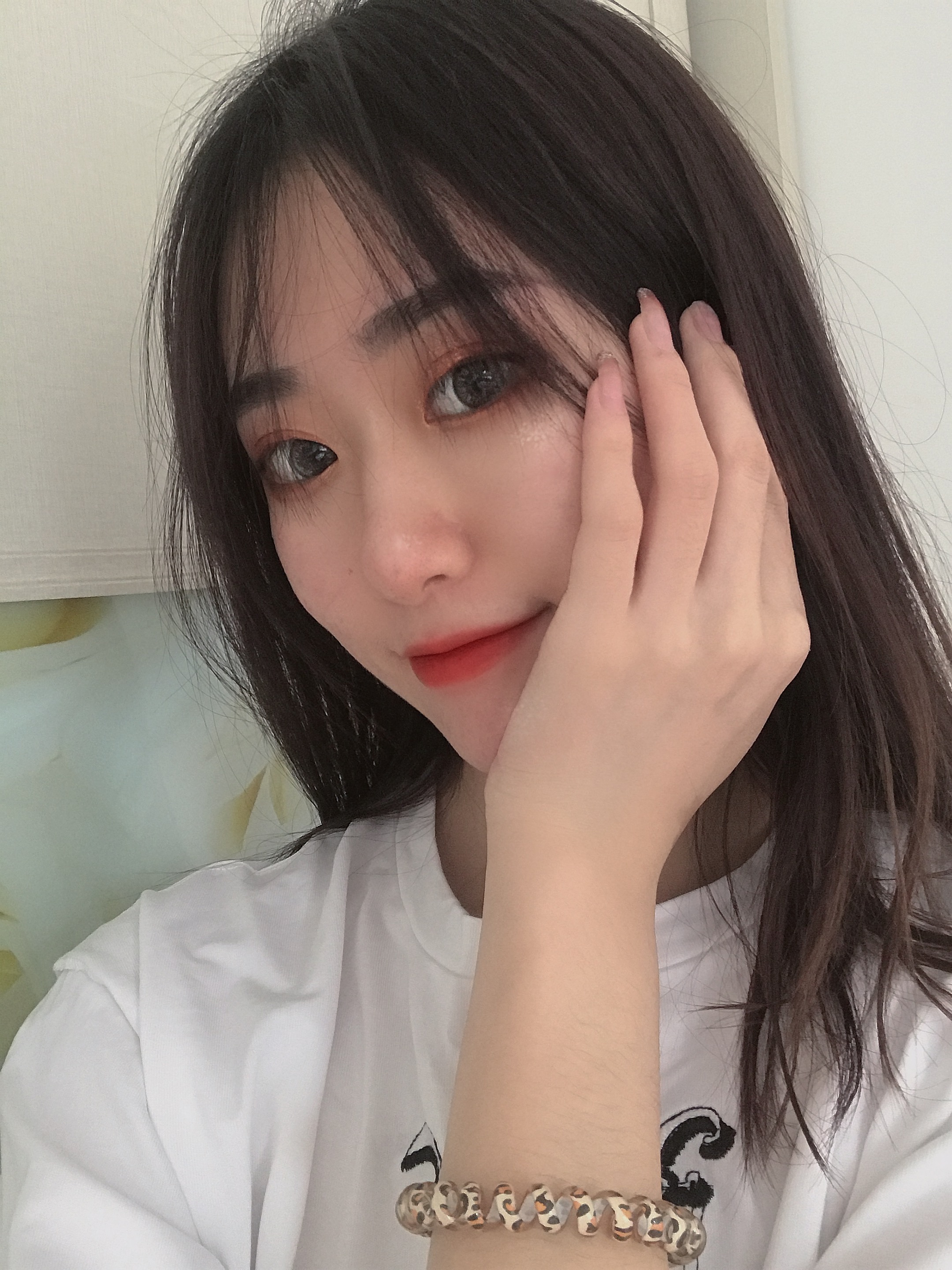 我的鼻子整体上恢复的很好,鼻子上面也没有出现挛缩的情况,北京刘风卓隆鼻案例