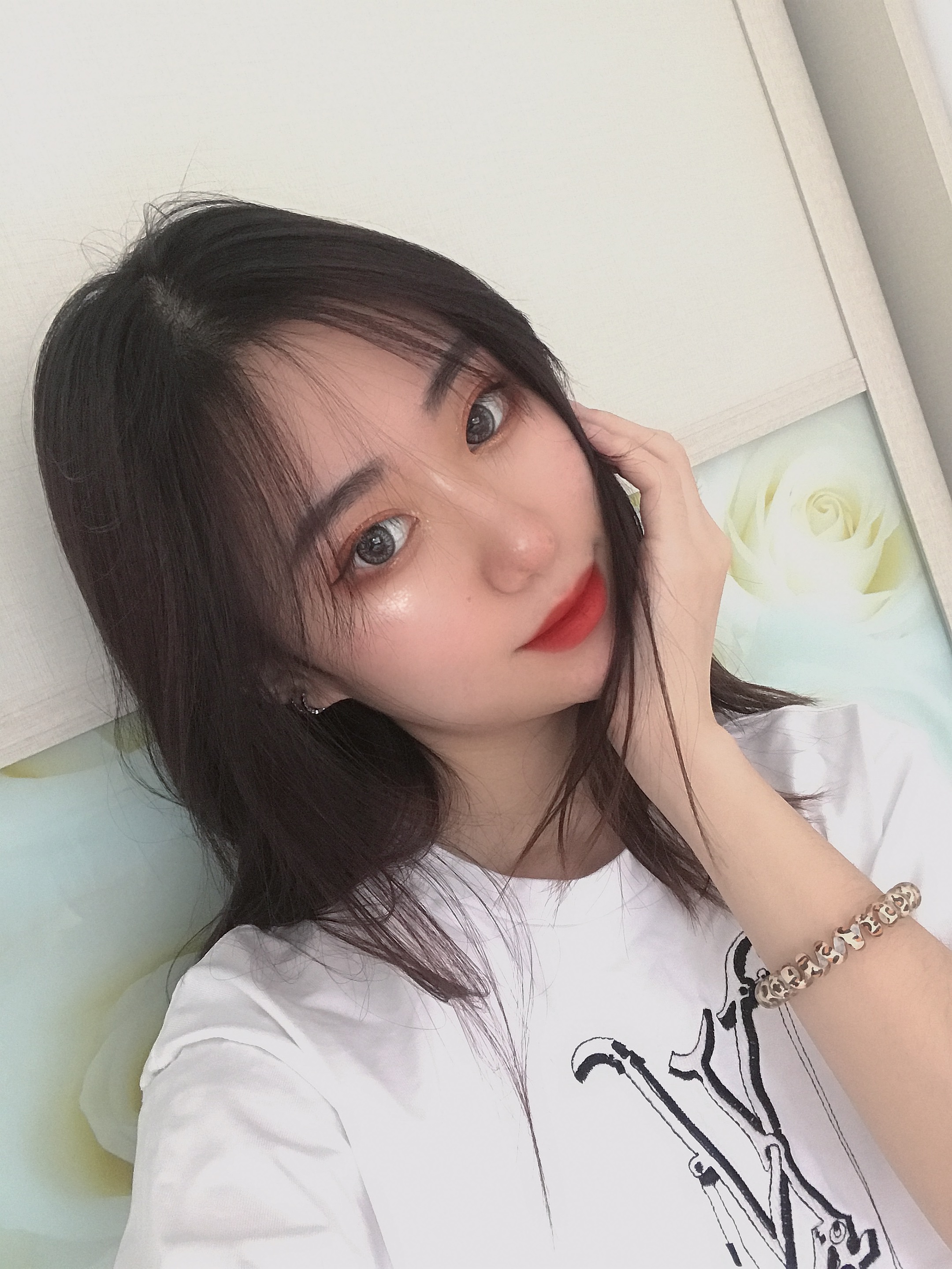 我的鼻子整体上恢复的很好,鼻子上面也没有出现挛缩的情况,北京刘风卓隆鼻案例