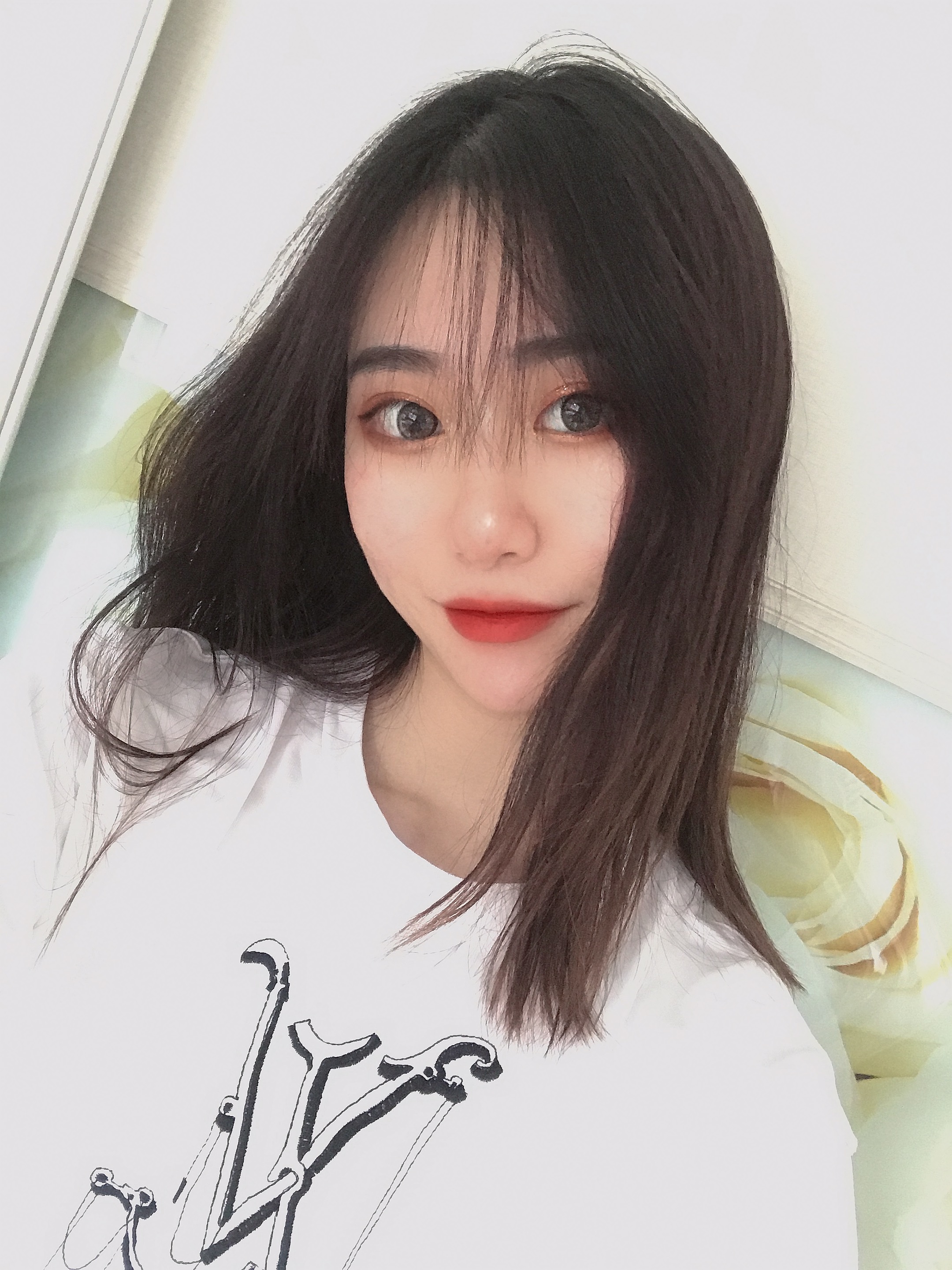 我的鼻子整体上恢复的很好,鼻子上面也没有出现挛缩的情况,北京刘风卓隆鼻案例