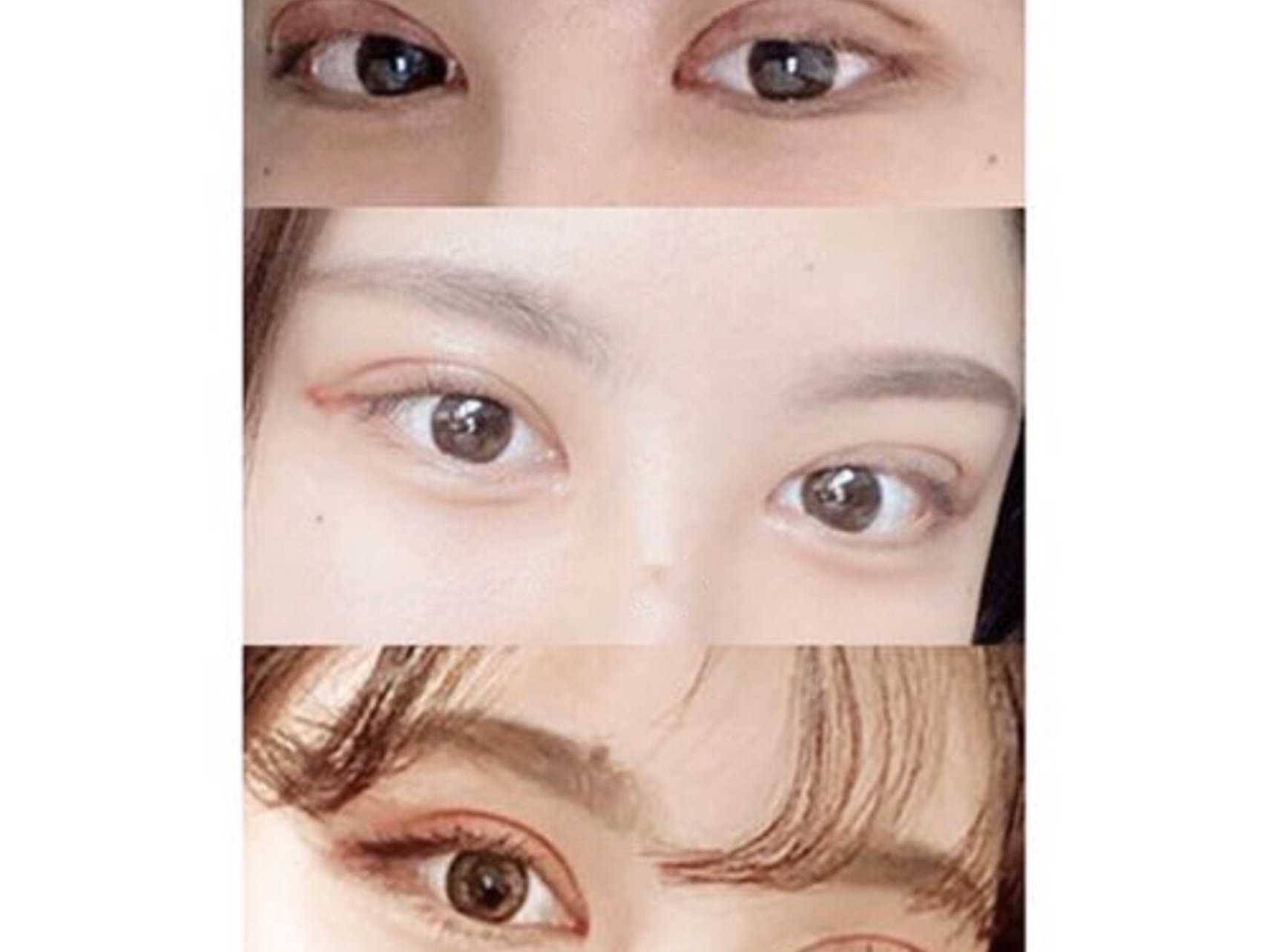我终于去做了双眼皮拉,现在还是有点肿胀 刘风卓割双眼皮案例图