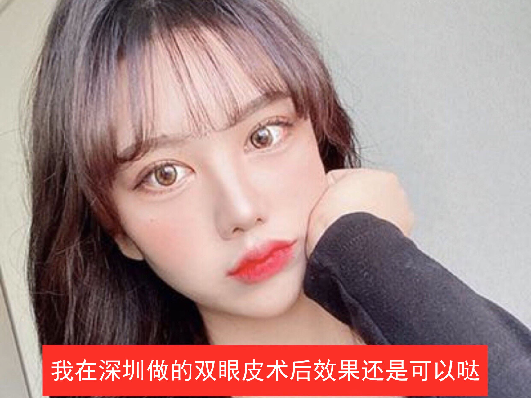 我终于去做了双眼皮拉,现在还是有点肿胀 刘风卓割双眼皮案例图