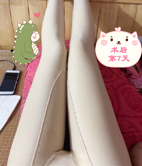 大腿两侧脂肪堆积过多,导致大腿腿型比例失衡 重庆曹阳丽格大腿吸脂案例