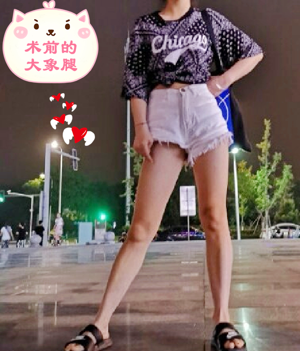 大腿两侧脂肪堆积过多,导致大腿腿型比例失衡 重庆曹阳丽格大腿吸脂案例