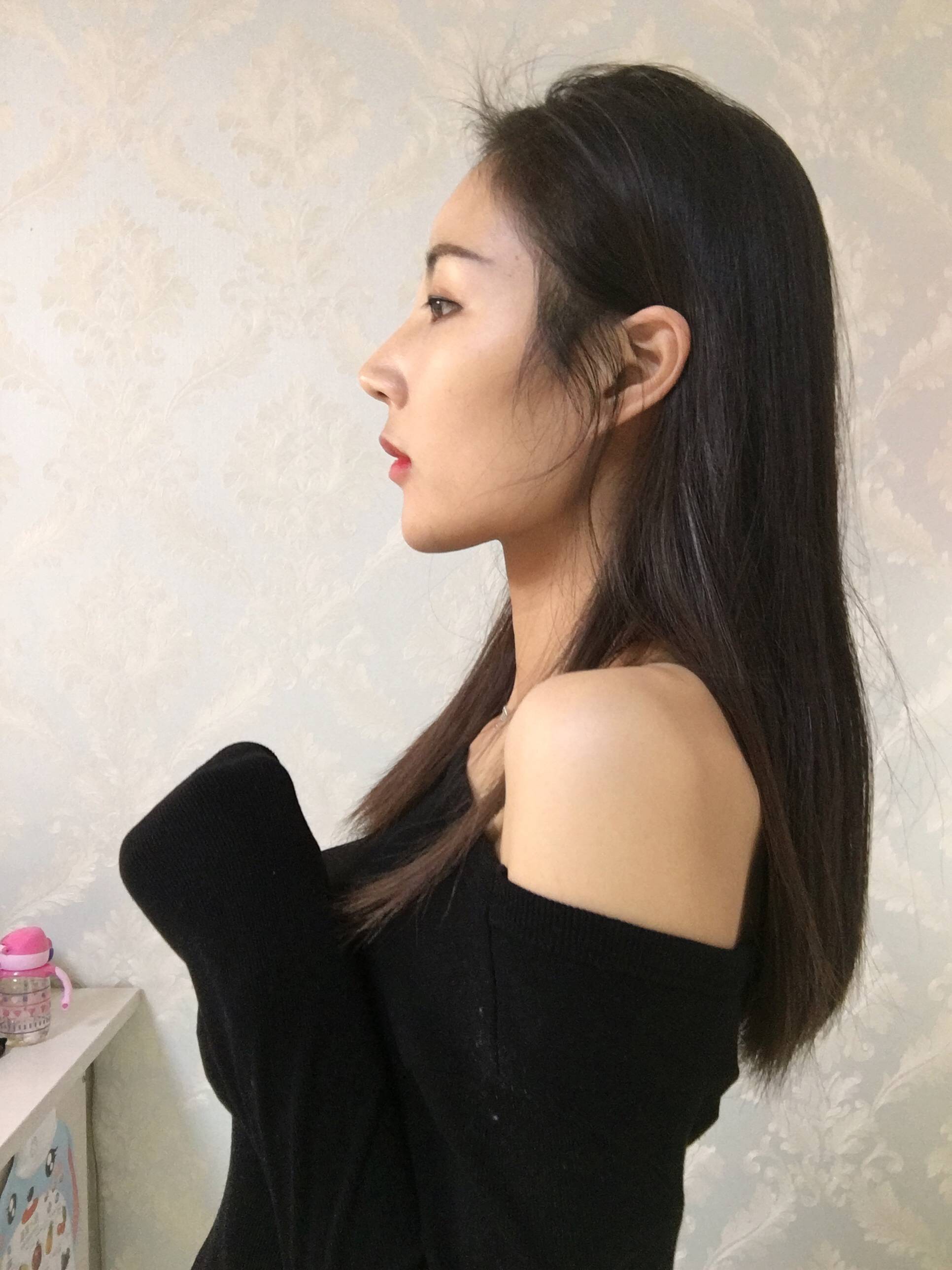 成都润美玉之光黄开亮隆鼻价格多少钱?好不好?案例图