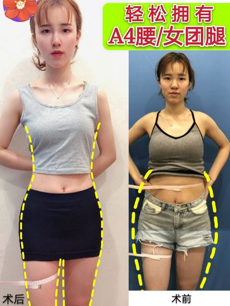 腿部粗壮,没有线条感。腰部、腹部赘肉堆积 全身吸脂(大腿+腰部+腹部)拯救了我