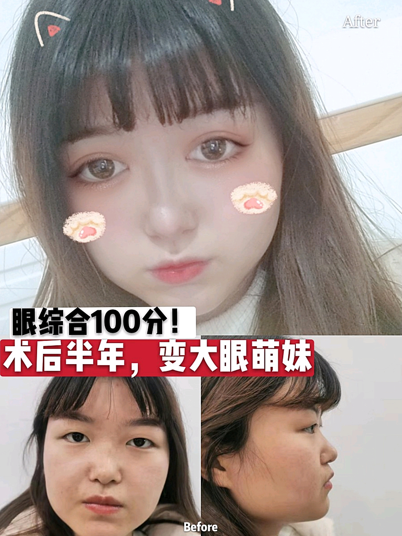双眼皮彻底稳定,没有人造的手术痕迹,形态美观宽窄适中。