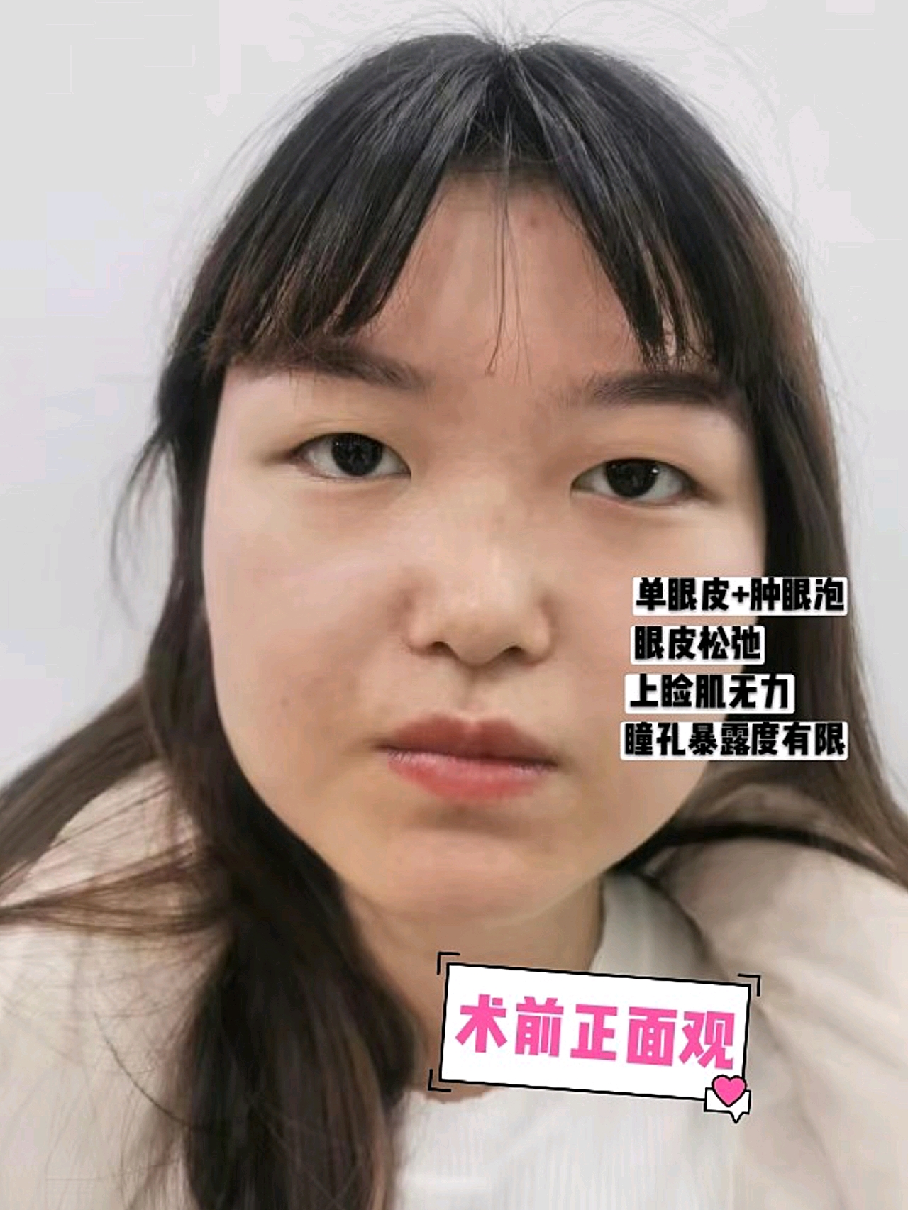 双眼皮彻底稳定,没有人造的手术痕迹,形态美观宽窄适中。