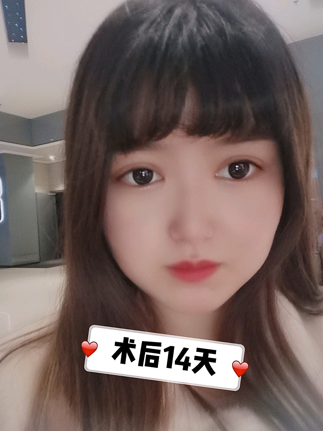 双眼皮彻底稳定,没有人造的手术痕迹,形态美观宽窄适中。