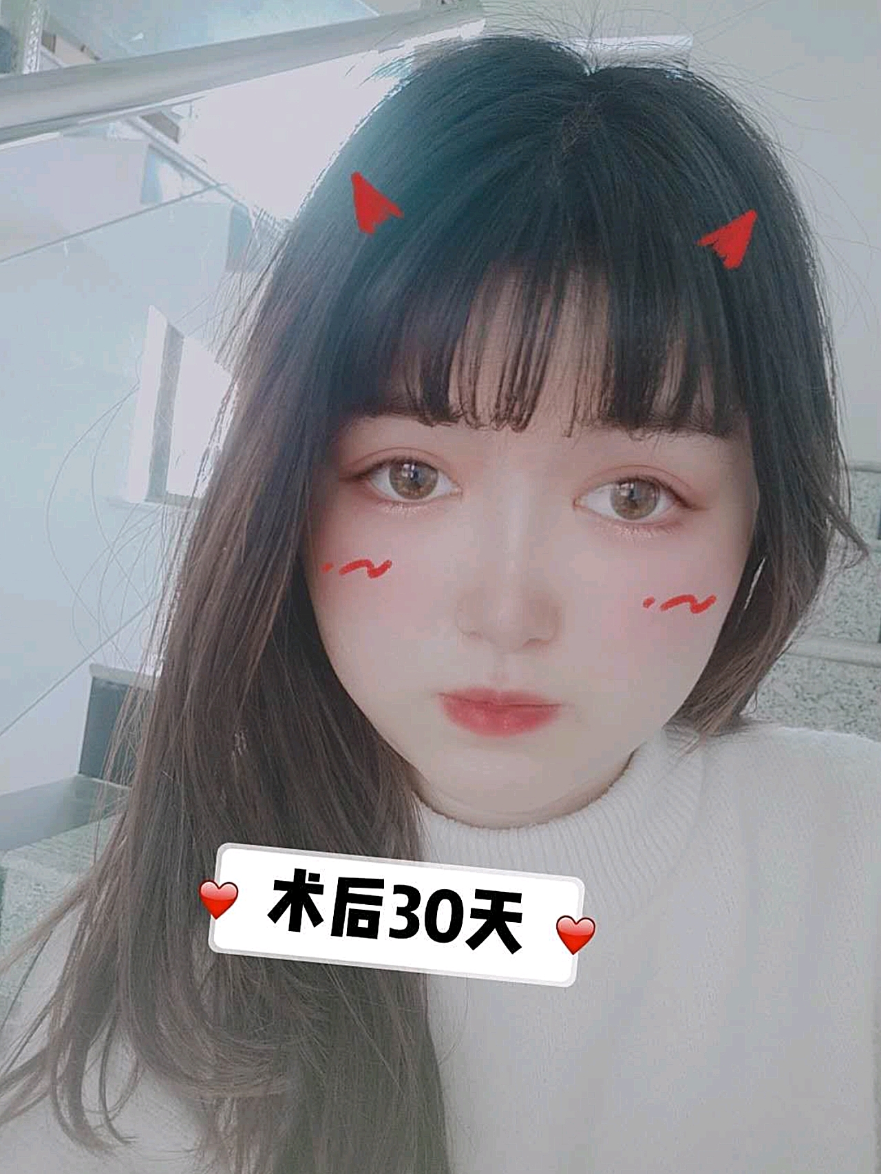 双眼皮彻底稳定,没有人造的手术痕迹,形态美观宽窄适中。