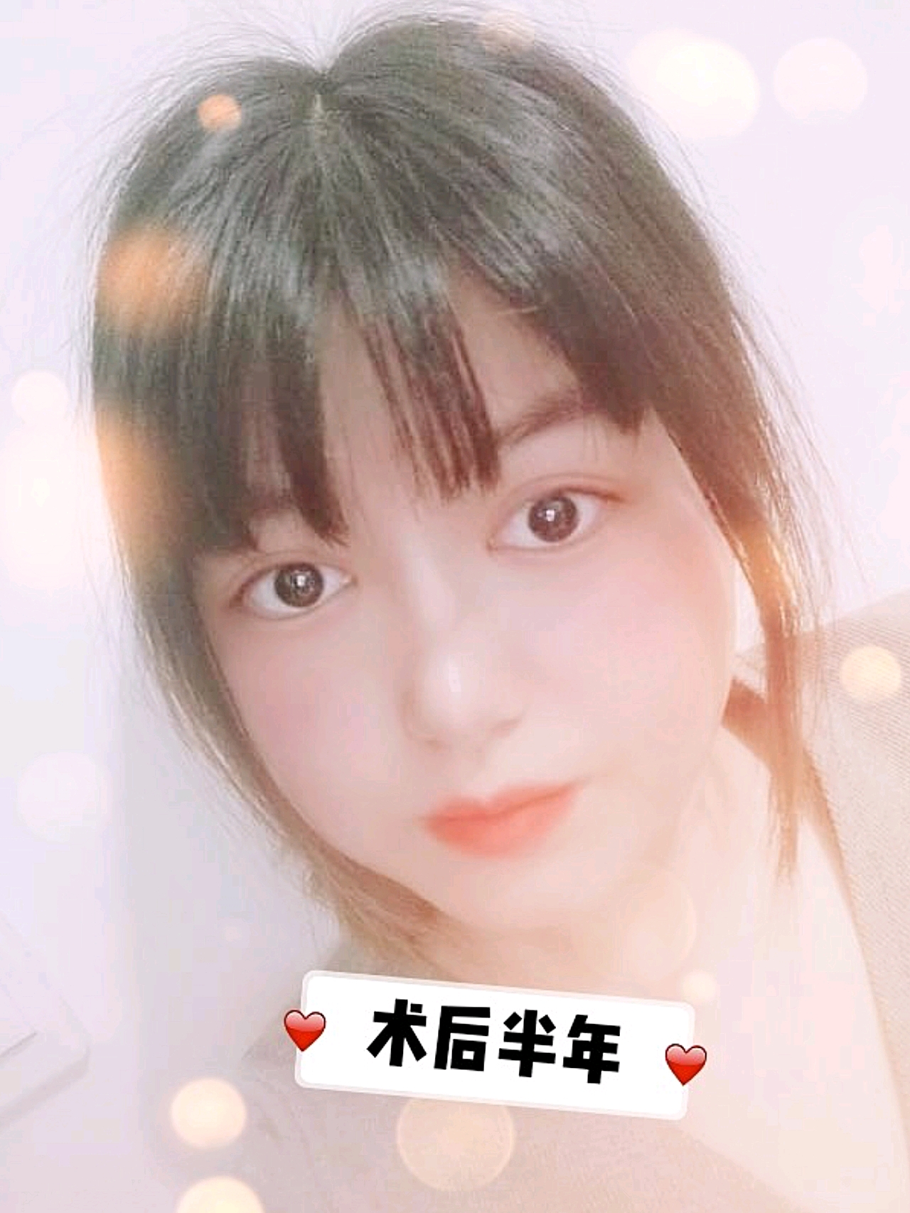 双眼皮彻底稳定,没有人造的手术痕迹,形态美观宽窄适中。