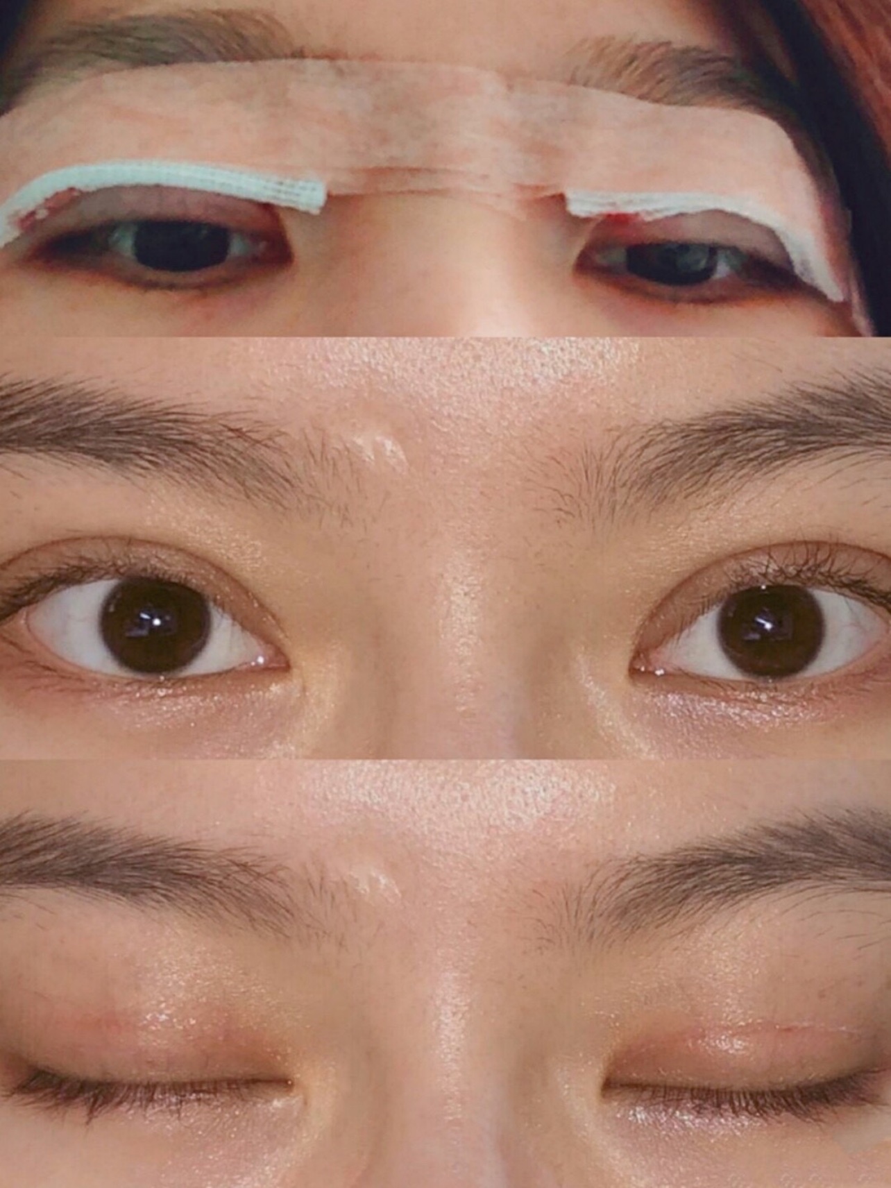 南京全切双眼皮无疤痕无增生术后恢复分享