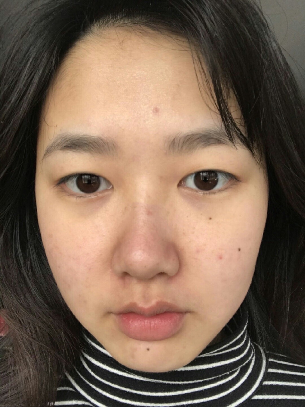 南京全切双眼皮无疤痕无增生术后恢复分享