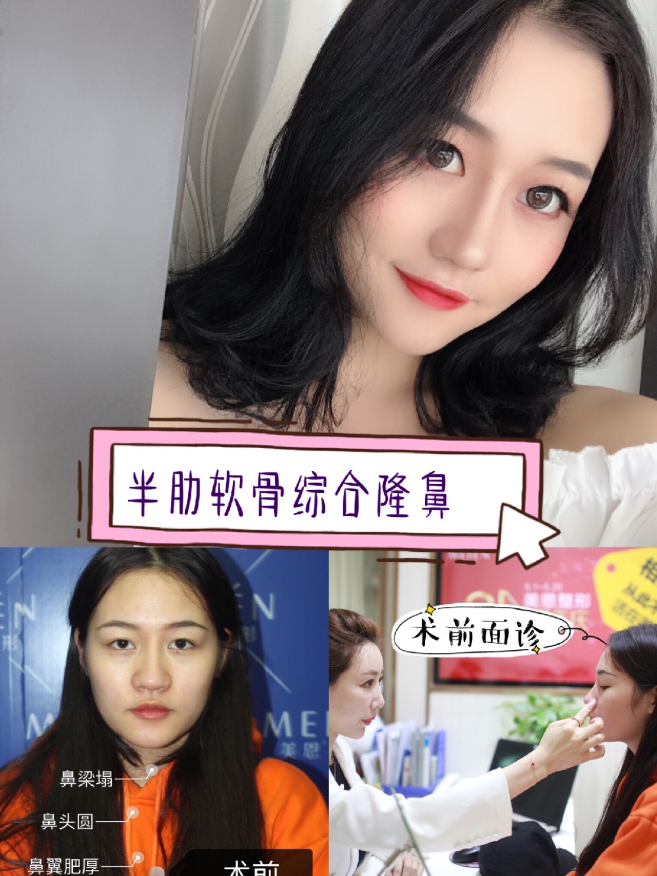 隆鼻究竟怎么才能做出一根既硬气又不缺乏柔美感的鼻子?