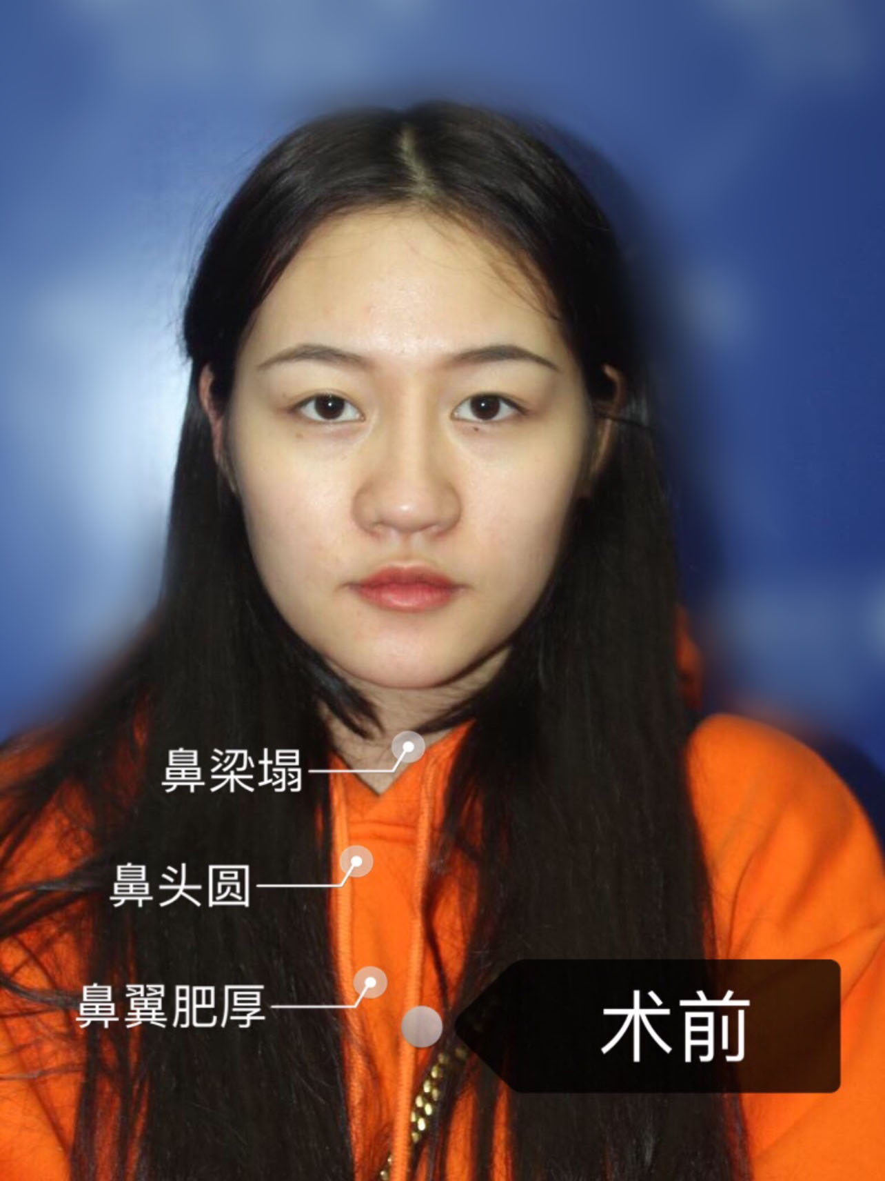 隆鼻究竟怎么才能做出一根既硬气又不缺乏柔美感的鼻子？