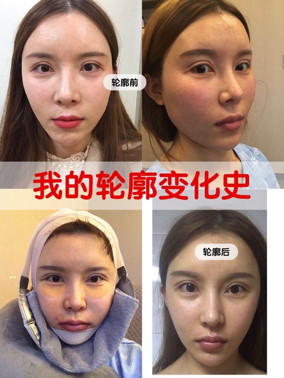 硬核换头,从菱形脸到柔和脸,我都经历了什么 上海第九人民医院 上海九院磨骨多少钱?案例图有吗?