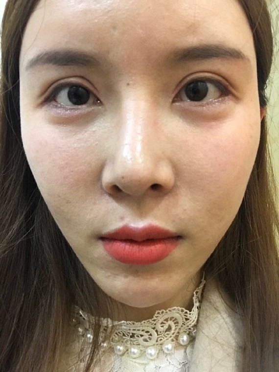 硬核换头,从菱形脸到柔和脸,我都经历了什么 上海第九人民医院 上海九院磨骨多少钱?案例图有吗?
