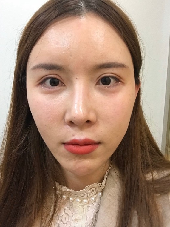 硬核换头,从菱形脸到柔和脸,我都经历了什么 上海第九人民医院 上海九院磨骨多少钱?案例图有吗?