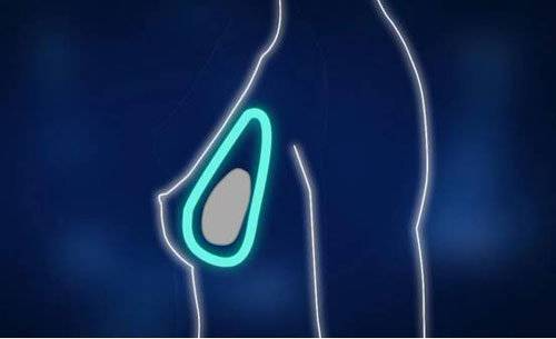 假体隆胸手术费用由什么决定?假体隆胸价格多少钱?价格表